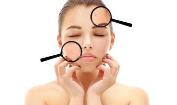 tipos de granos causas acne